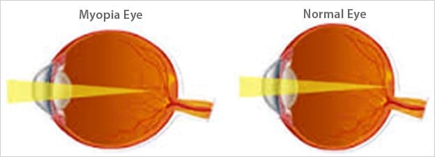 Infographic showing normal eye vex myopic eye Maple Grove Eye Doctors at Pearle Vision