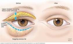 Bags under Eyes Maple Grove Eye Doctors at Pearle Visionco