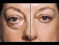 Woman with Bag under right eye and no bag under left eye . Maple Grove Eye Doctors at Pearle Vision