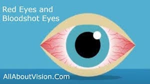 Red Eyes Maple Grove Eye Doctors at Pearle Vision