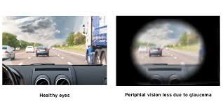 Glaucoma Vision Loss Maple Grove Eye Doctors at Pearle Vision