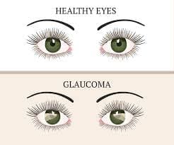 Comparison of glaucoma affected eyes versus healthy eyes. Maple Grove Eye Doctors at Pearle Vision