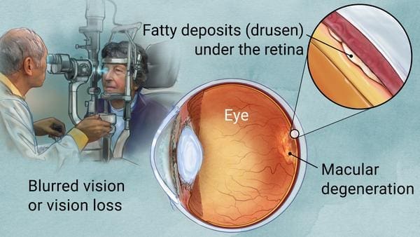 AMD Graphic Maple Grove Eye Doctors at Pearle Vision